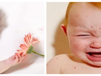 行业新闻儿童湿疹反反复复，您有在家安装家用除湿产品吗？